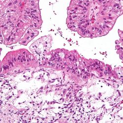 Micrograph of a mucinous ovarian carcinoma stained by H&E. (Wikimedia Commons | CC BY-SA 3.0)